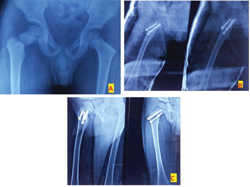 Anteroposterior radiograph of a 5-year-old girl with type III fracture (A). The girl was managed by OR + screwing and a one-leg spica cast. (B). Although the child had type III AVN on final follow-up, the clinical result was considered fair (C).